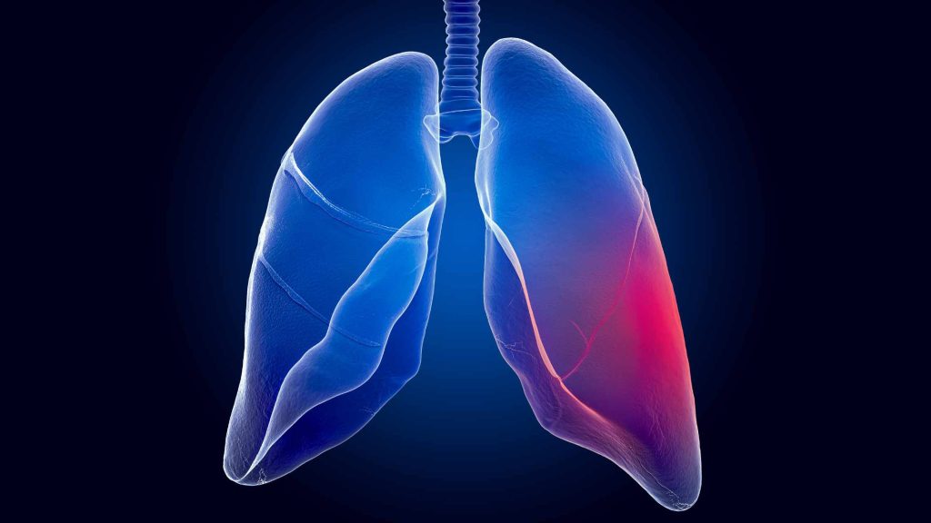 Lung Cancer Treatment